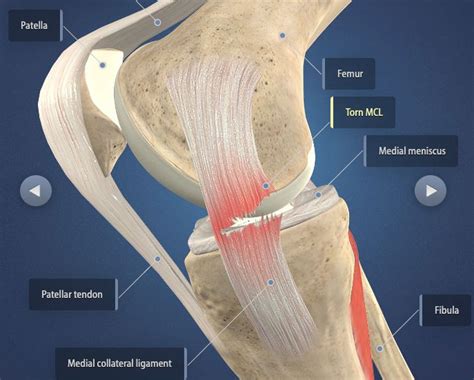 acl mcl tear test|acl and mcl tear together.